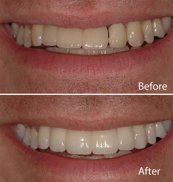 Before-and-after smile transformation