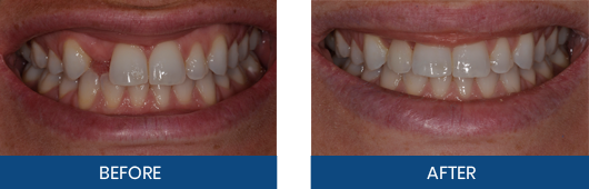 Dental implant and crown before-and-after result