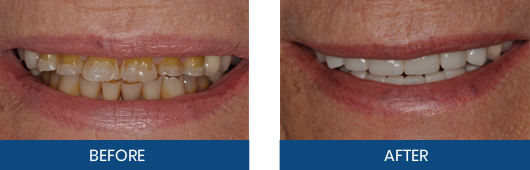 Dental crown restoration before and after