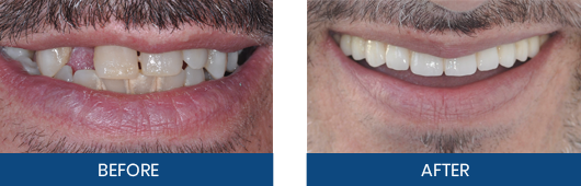 Dental implant bridge before-and-after result
