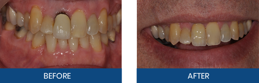 Customized crown before-and-after result