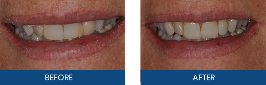 Restorative crown before-and-after result