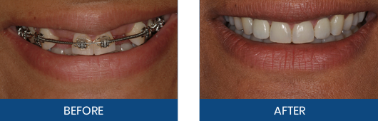 Implant crown restoration before and after