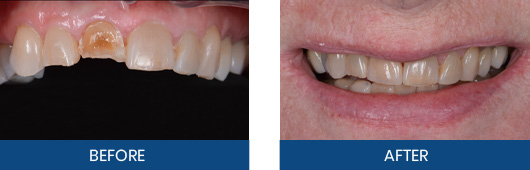 Dental crown before-and-after result