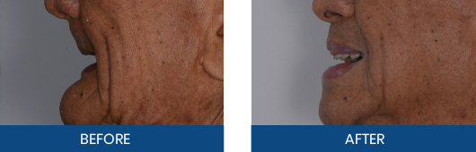 Dentures before-and-after result