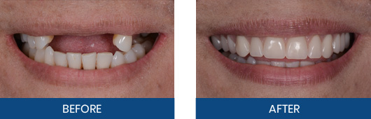 Immediate denture before-and-after result